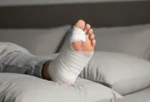 Pós-operatório da cirurgia de joanete