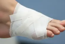 Quantos dias é a recuperação de cirurgia de joanete